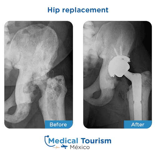 Patient before and after hip replacement