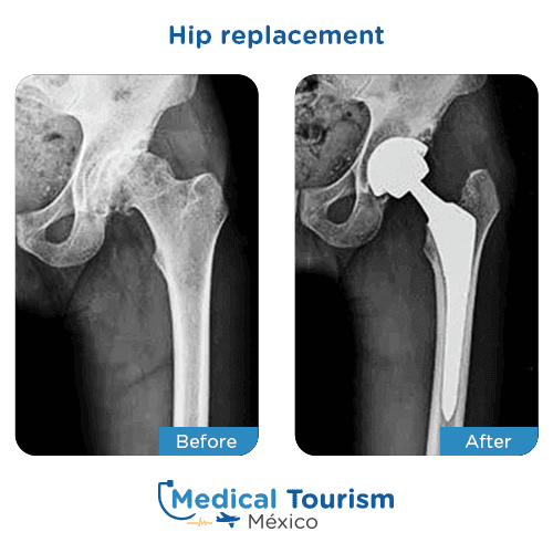 Patient before and after hip replacement