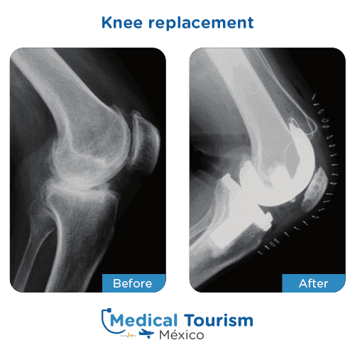Patient before and after Knee replacement