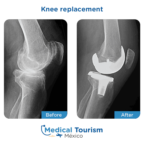 Patient before and after Knee replacement