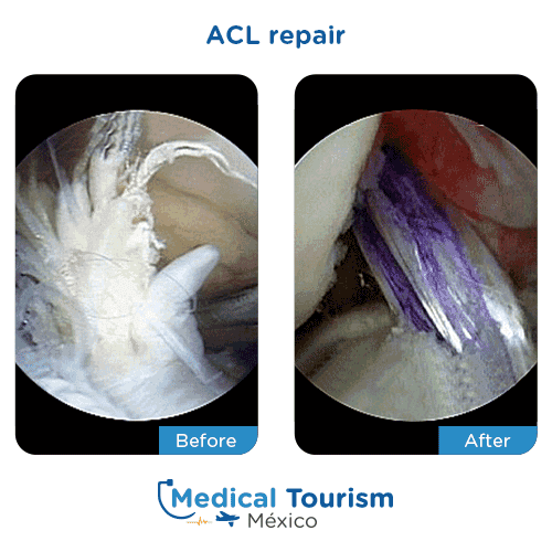 Patient before and after acl repair