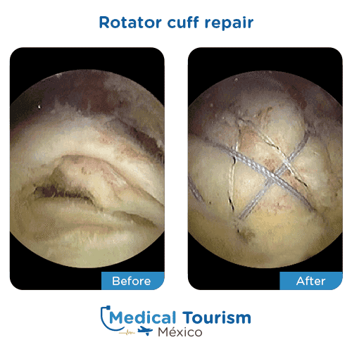 Patient before and after rotator cuff repair