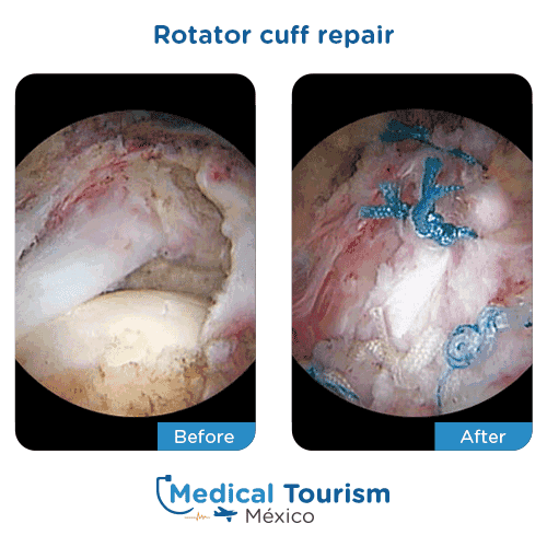 Patient before and after rotator cuff repair
