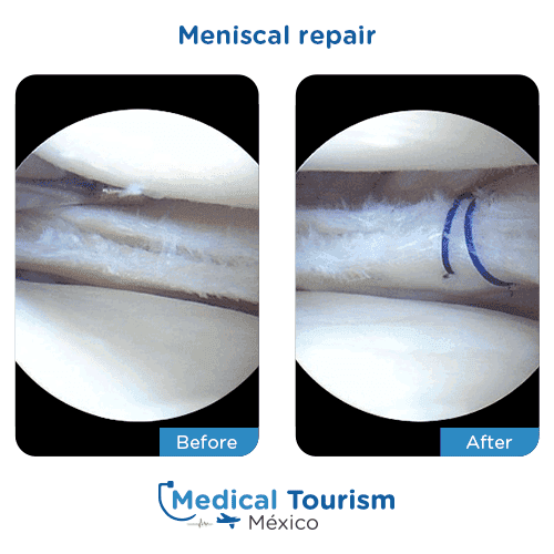 Patient before and after meniscal repair
