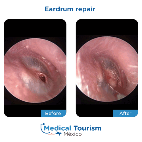 Eardrum repair before and after