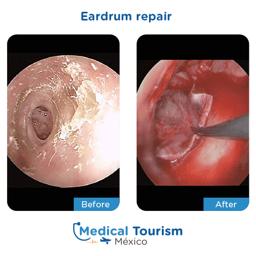 Eardrum repair before and after