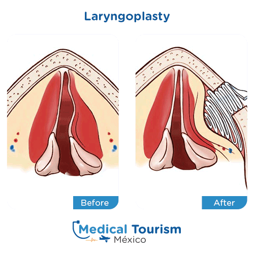 Illustrative images Laryngoplasty