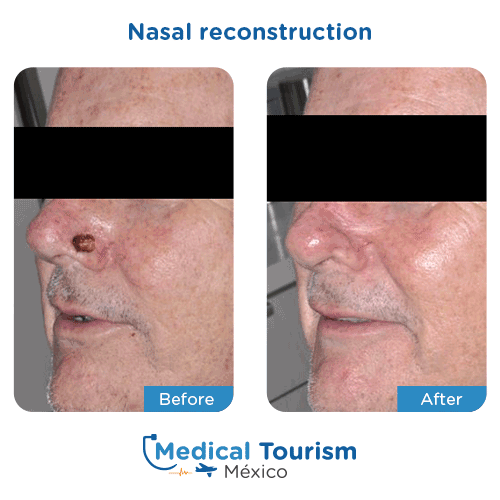 Nasal reconstruction before and after