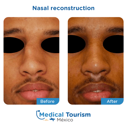 Nasal reconstruction before and after