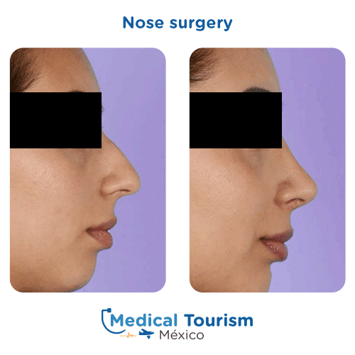 Nose surgery before and after