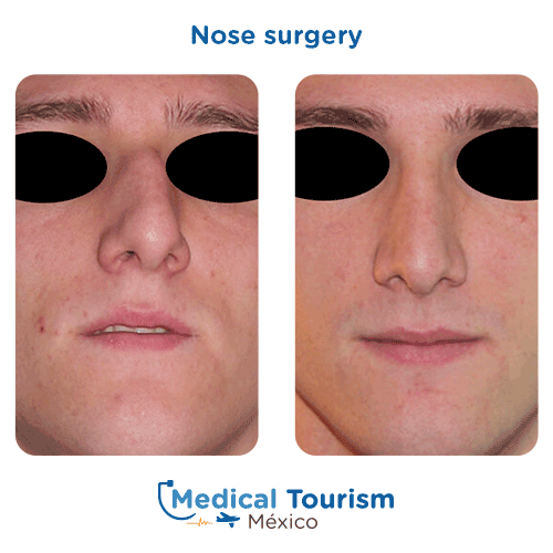 Nose surgery before and after