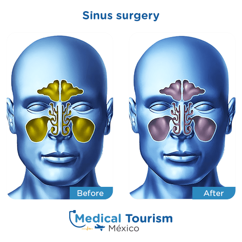 Illustrative image of sinusitis