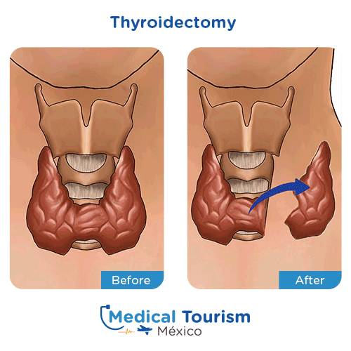 Illustrative image of Thyroidectomy