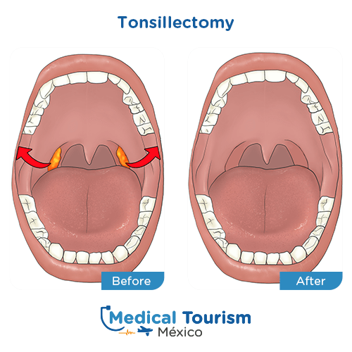 Illustrative image of Tonsillectomy