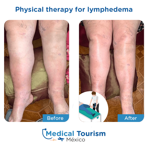 Illustrative image of lymphedema