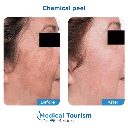 Patient before and after glycolic acid peel