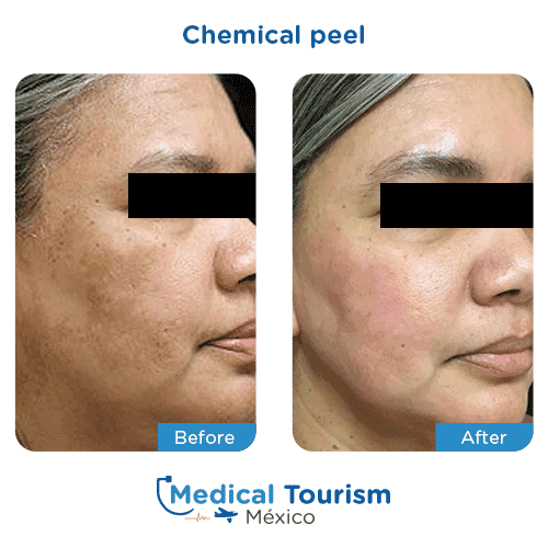 Patient before and after glycolic acid peel