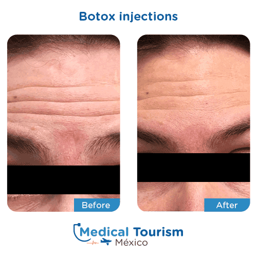 Patient before and after botox injections
