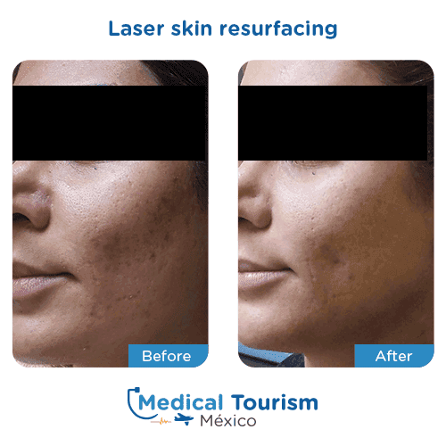 Patient before and after laser skin resurfacing
