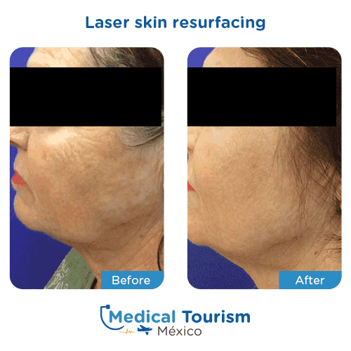 Patient before and after laser skin resurfacing