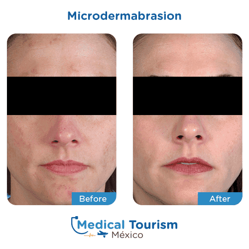 Patient before and after microdermabrasion