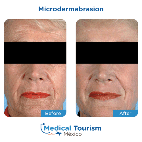 Patient before and after microdermabrasion