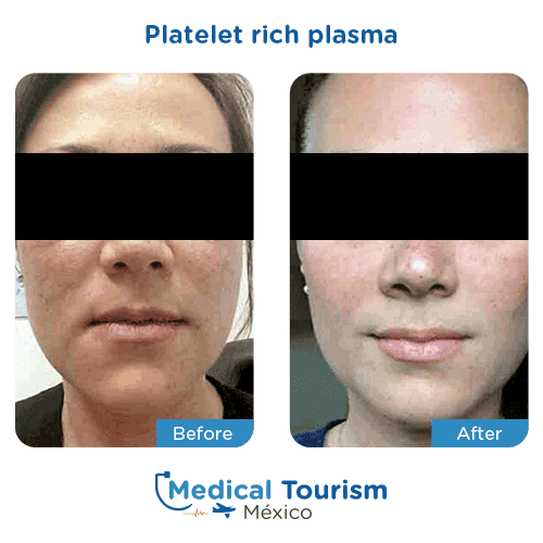 Patient before and after platelet rich plasma