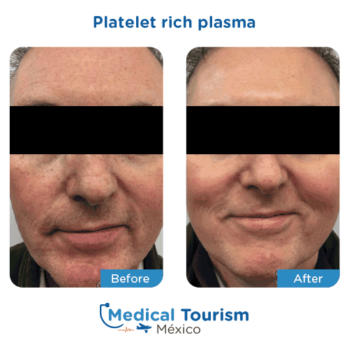 Patient before and after platelet rich plasma