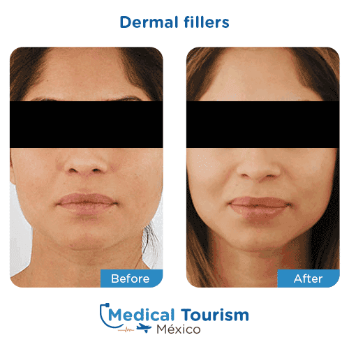 Patient before and after dermal fillers
