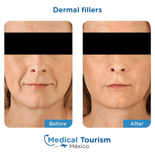 Patient before and after dermal fillers
