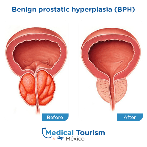 Illustrative image of Benign Prostatic Hyperplasia
