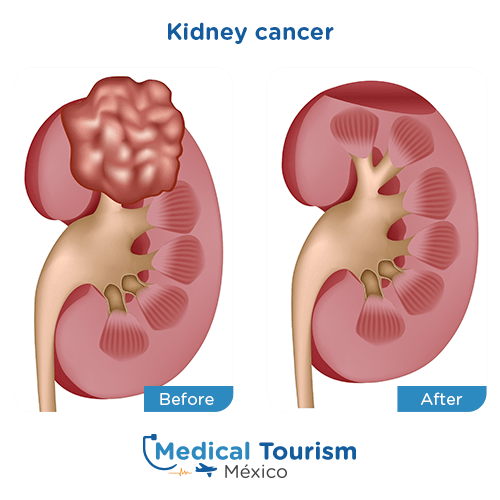 Illustrative image of Kidney cancer