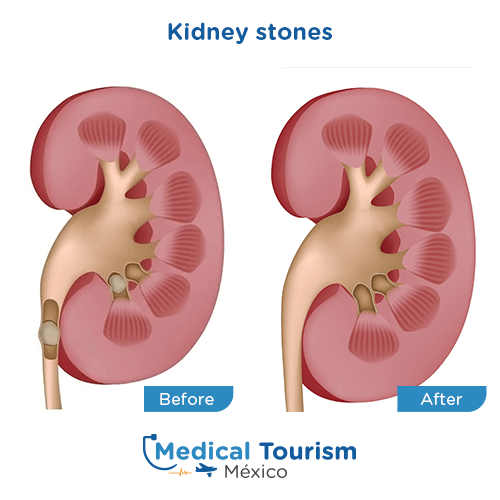 Illustrative image of Kidney stones