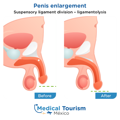 Illustrative image of Penis enlargement