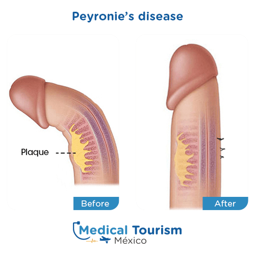 Illustrative image of Peyronie’s disease