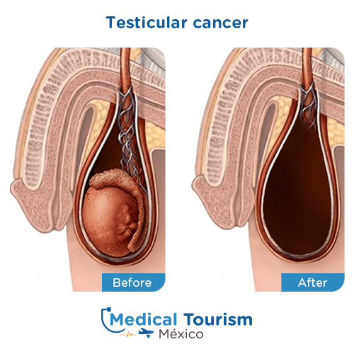 Illustrative image of Testicular cancer