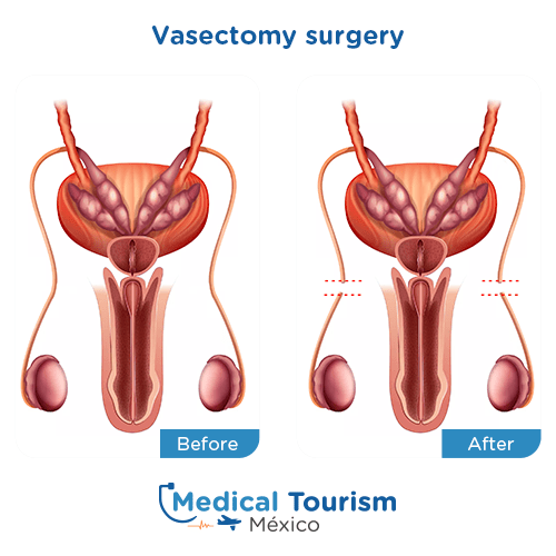 Illustrative image of Vasectomy surgery
