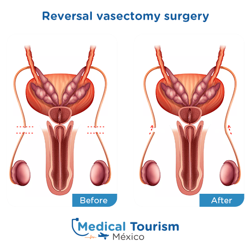 Illustrative image of Reversal Vasectomy surgery
