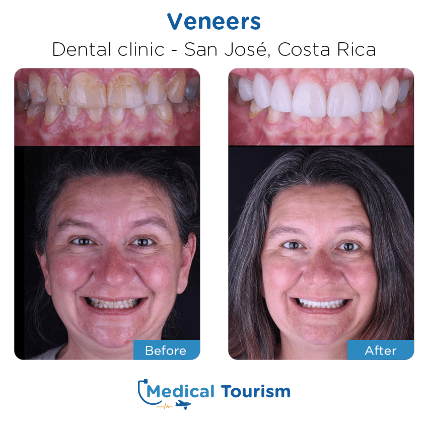 dental clinic before and after of patients in San José