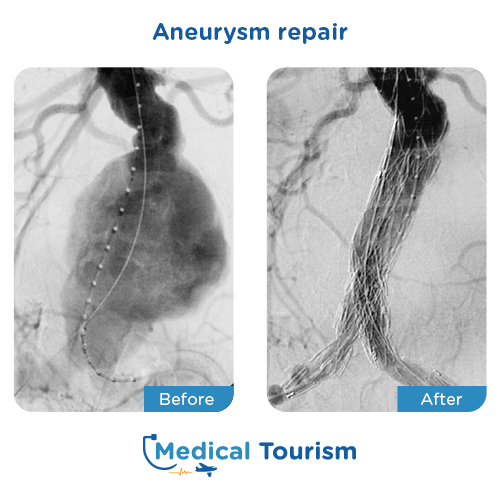 Aneurism before and after medical tourism international
