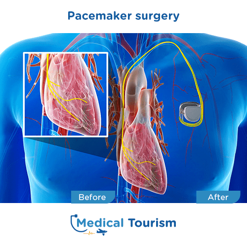 Pacemaker before and after medical tourism international