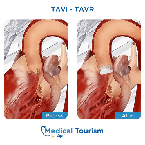 Tavr before and after medical tourism international