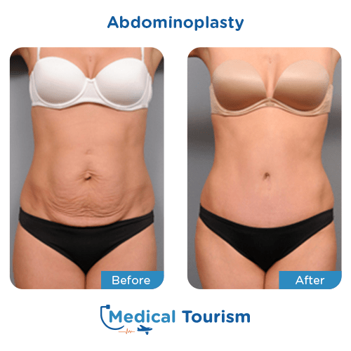 Abdominoplasty before and after medical tourism international
