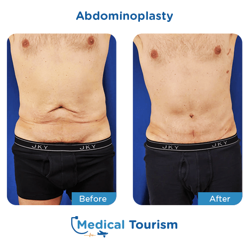 Abdominoplasty before and after medical tourism international