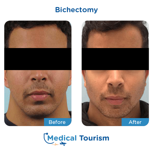 Bichectomy before and after medical tourism international