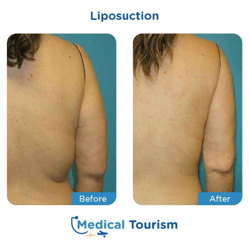 Liposuction before and after medical tourism international
