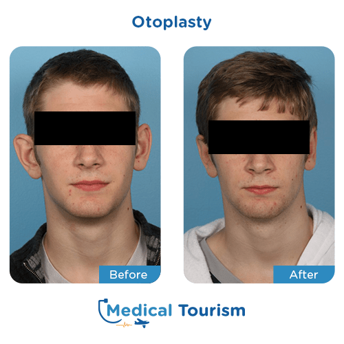 Otoplasty before and after medical tourism international