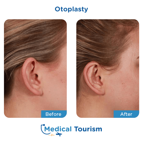 Otoplasty before and after medical tourism international