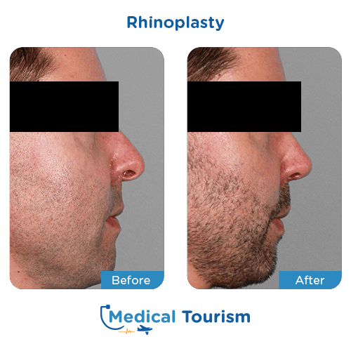 Rhinoplasty before and after medical tourism international