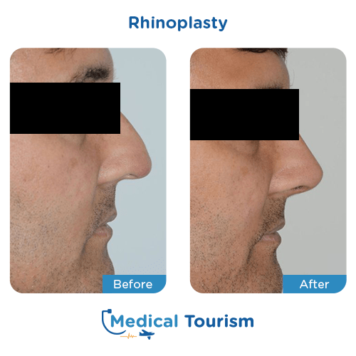 Rhinoplasty before and after medical tourism international